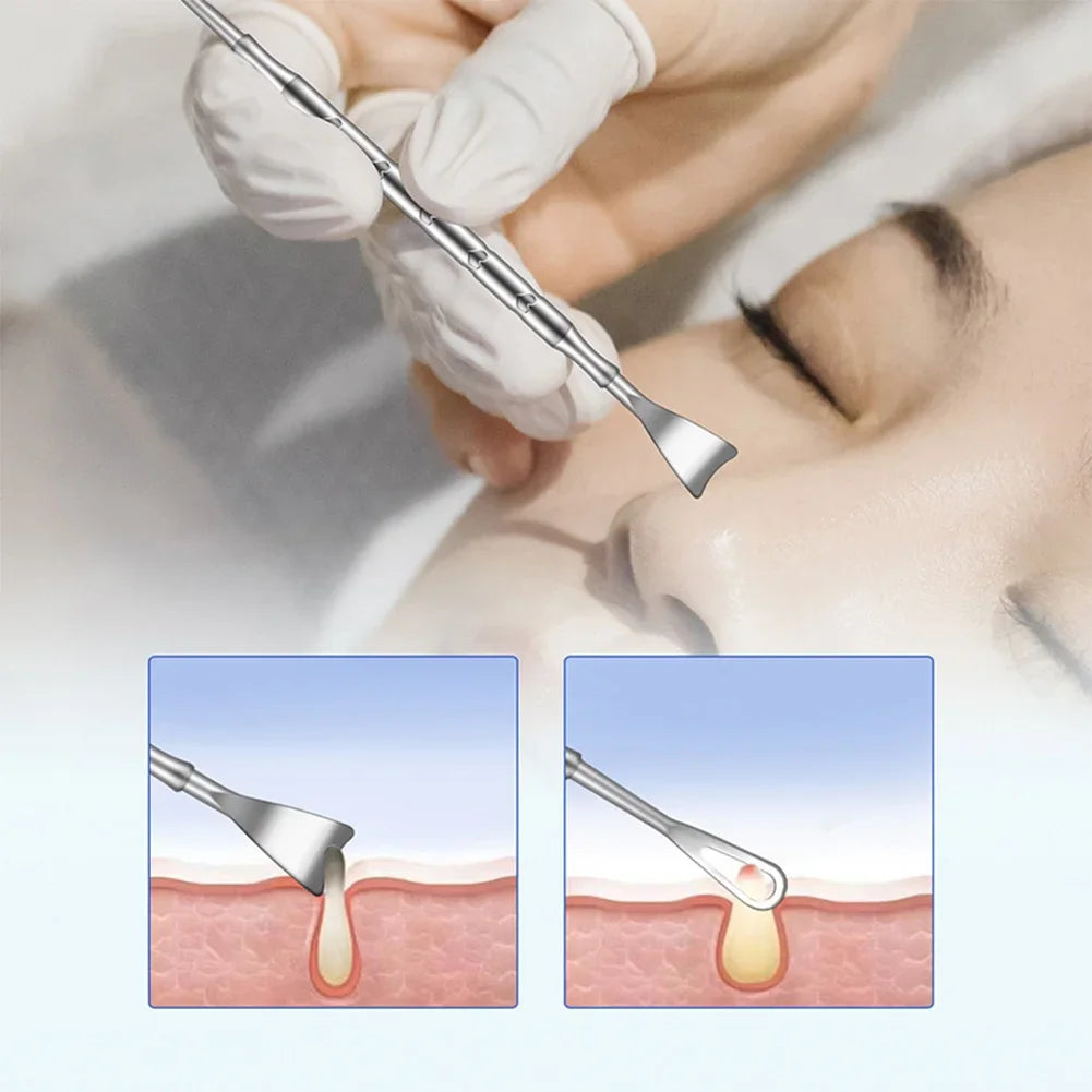 Double head stainless steel blackhead remover tool with black and silver tips, professional blemish extractor for face skin care.